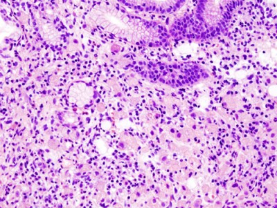 Gastric_signet_ring_cell_carcinoma_histopatholgy_(1).jpg